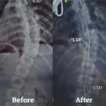 Boston Brace - Image 3